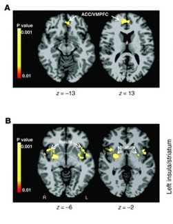 Brain-imaging results from the glucose and food-cue study.